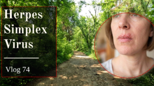 Herpes Simplex Virus - Vlog 74